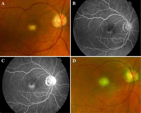 Chorioretinitis