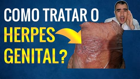 Problemas De Pele Na Regi O Genital Causas Diagn Stico Off