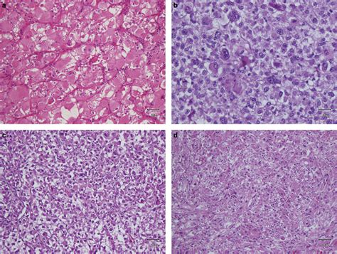 Spectrum Of Morphologic Features Of Epithelioid Cells In Epithelioid Download Scientific