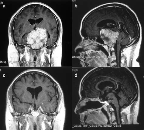 T1 Weighted Image Mri With Contrast Enhancement Of A Giant Clivus Download Scientific Diagram