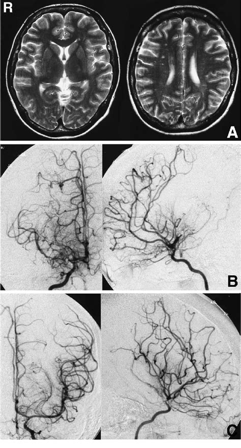 Case 4 A Preoperative T 2 Weighted Magnetic Resonance Images