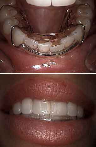 Hawley Retainer Before And After