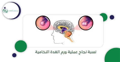 نسبة نجاح عملية ورم الغدة النخامية دكتور إسلام الاجهوري