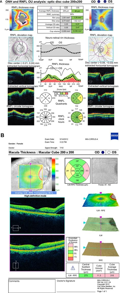 OCT of the optic nerve and macula. (A) Retinal nerve fiber layer... | Download Scientific Diagram