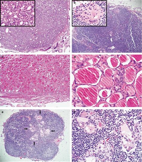 Non Invasive Encapsulated Follicular Variant Papillary Thyroid