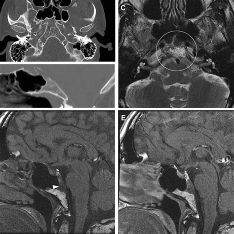 Chordoma Magnetic Resonance Imaging Of A Skull Base Chordoma Arising Download Scientific