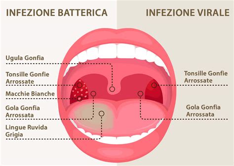 Faringite Cause E Sintomi Curare Il Mal Di Gola