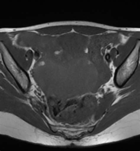 Ovarian Torsion