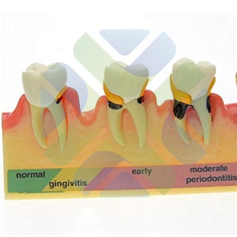 Modelo Dental De Enfermedad Periodontal Modelos De Patologia Dentales