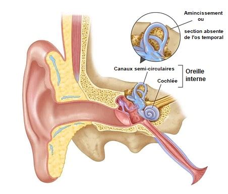 D Hiscence Du Canal Semi Circulaire Dsc Balance Dizziness Canada