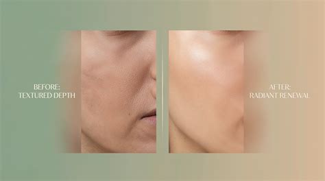 Microdermabrasion Before and After Wrinkles: Real Results & What to
