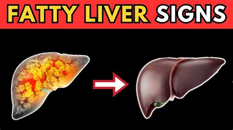 8 Signs That Could Indicate Fatty Liver Disease 8 Warning Symptoms You Should Not Ignore Youtube