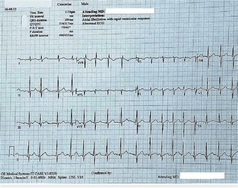 The Initial Electrocardiogram Showing Atrial Fibrillation With A Rapid