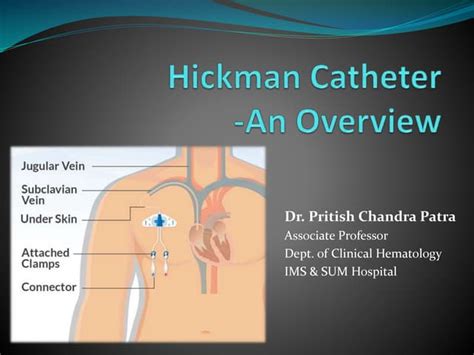 Hickman Catheter- An overview. Details about Hickman, insertion, care ...