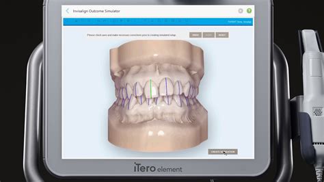 Itero™ Scanner Tutorial Invisalign® Outcome Simulator Youtube