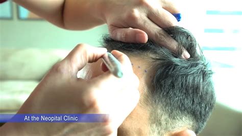 Turkey Fue Hair Transplant Vlog Step By Step All Procedures Youtube