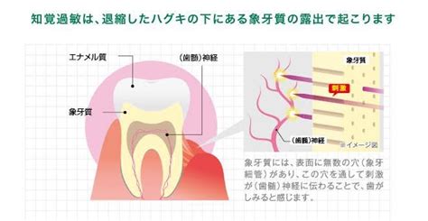 知覚過敏について エス歯科クリニック 横浜みなとみらい