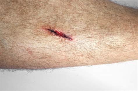 Laceration Cut