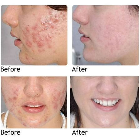 Upgraded New AuQuest Acne Removal Cure Gel Scar Marks Acne Treatment ...