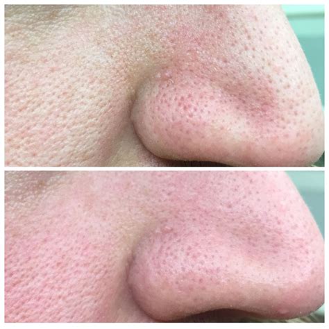 Taken Within Minutes Of Using The New Microdermabrasion Plus Set