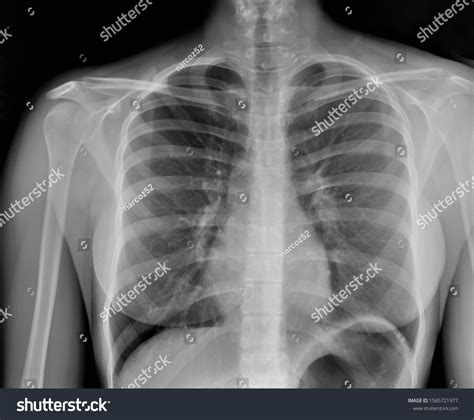 Chest Xray Pneumonia Emphysema Pulmonology Diagnosis Foto Stock