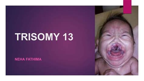 Trisomy 18 And Trisomy 13 Pptx