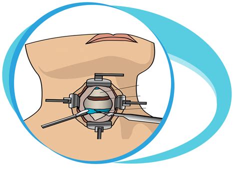 Cervical Surgery In Iran Medpersia Medical Tourism