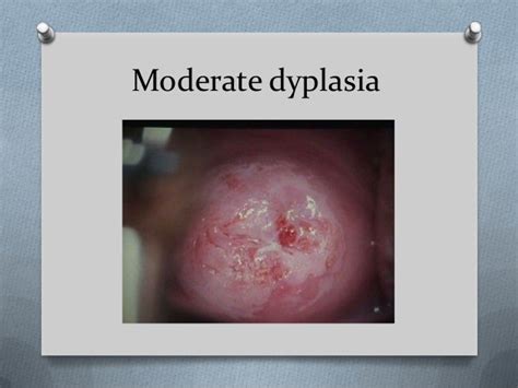 Cervical dysplasia