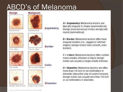 Ppt Malignant Melanoma Powerpoint Presentation Free Download Id