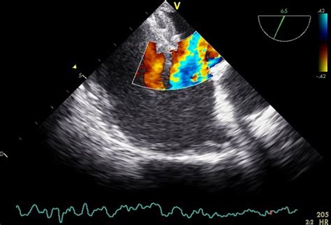 Case Of Delayed Diagnosis Of Fenestrated Atrial Septal Defect