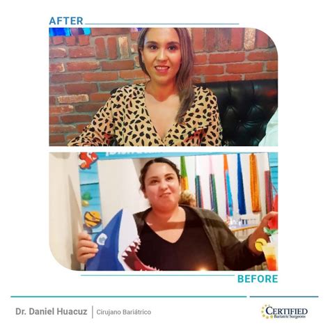 Weight Loss Surgery In Mexico Dr Faustino Daniel Huacuz