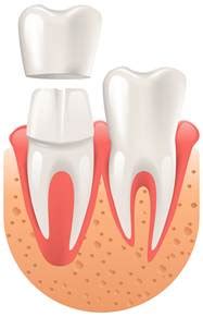 Couronne Dentaire Zircone C Ramique M Tal C Ramique