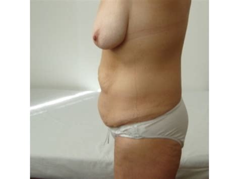 Abdominoplastie Hyron Ars Medica Chirurgie Plastica Bacau