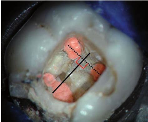 Pdf Access Cavity Preparation