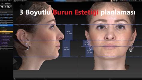 Burun estetiğinde 3 boyutlu ameliyat planlaması nasıl yapılır 3D