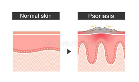 Cross Section Of Psoriasis Skin Flat Vector Illustration Stock Vector