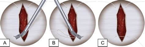 Commercial Suture Passer Improves Efficiency And Ease Of Use Versus