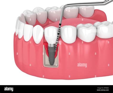 3d Render Of Human Jaw With Peri Implantitis Disease And Periodontal