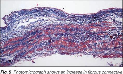 Figure 2 From Surgical Treatment Of A Giant External Iliac Vein