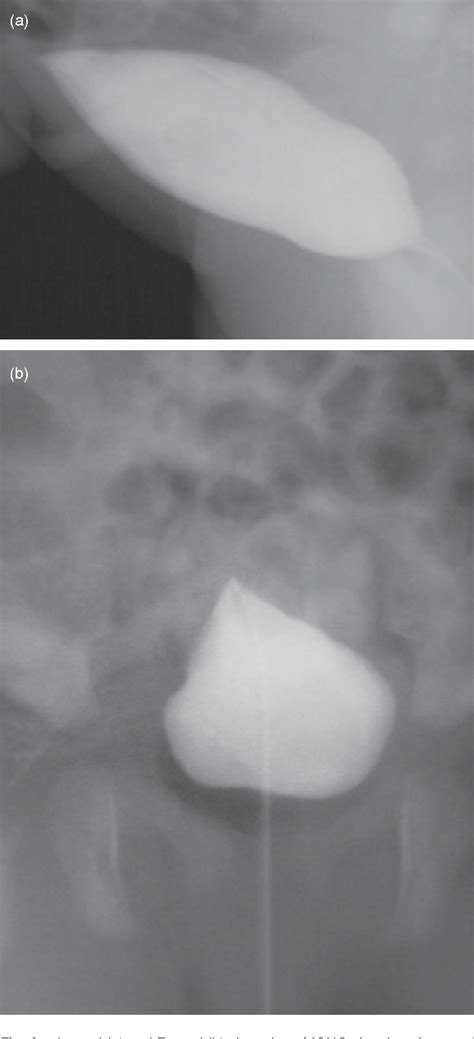 Patent Urachus In A Neonate Findings At Micturating Cystourethregram