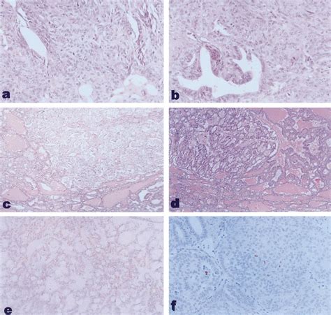 A B Histological Features Of The Thyroid Tumor Of Individual III 1