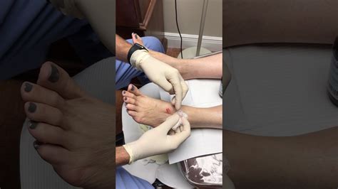 Aspiration And Drainage Cyst From Foot Youtube