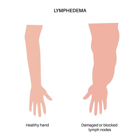 Lymphedema After Breast Cancer: Frequency, Incidence and What Increases ...