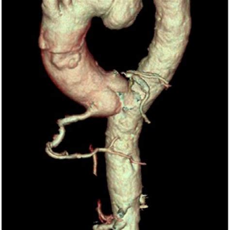 Cardiac Ct Sacciform Aneurysm Of The Thoracic Aorta On D Vr