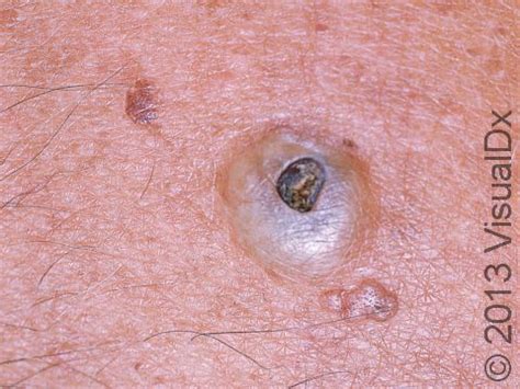 sebaceous cyst sites infoupdateorg