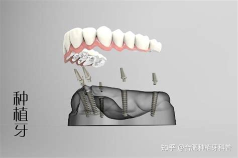 合肥种植牙费用是多少工资多少可以种牙？ 知乎