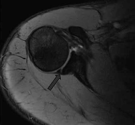 Posterior Labral Tear As Seen On Axial Mr Arthrogram Image The Arrow Download Scientific