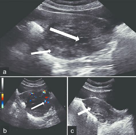 A 21 Year Old Female With Left Ovarian Sertoli Leydig Cell Tumor A