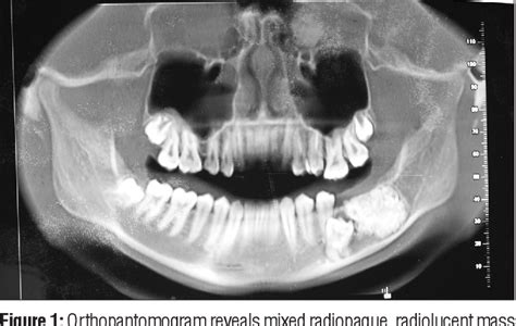 A Rare Case Of Ameloblastic Fibro Odontoma Of Mandible With Literature