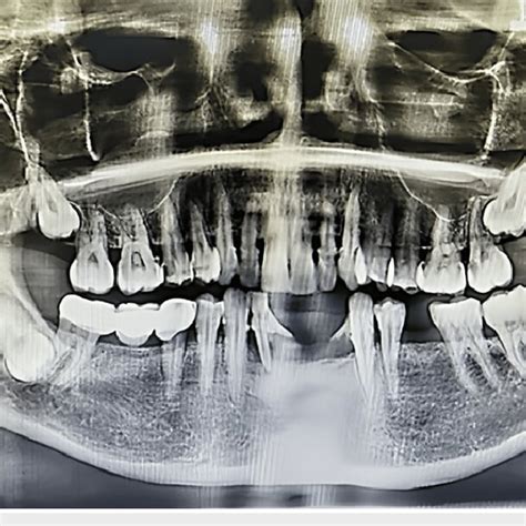 Orthopantomograph Showing Inverted Impacted Mandibular Third Molar